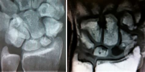 Scaphoid Fracture Can Be Associated With Unfavourable Loss Of