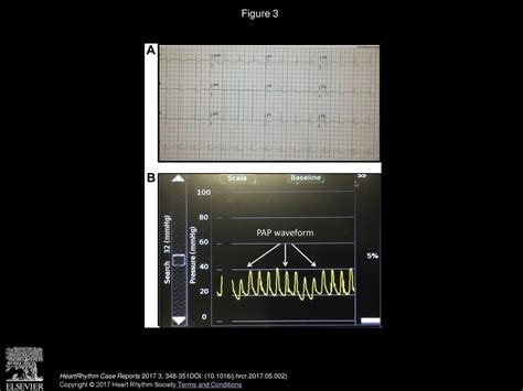 Pulmonary Arterial Pressure Sensing In A Patient With Left Ventricular