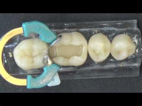 Como Fazer Restaura Es Classe Ii Sdr Matriz Palodent E Resina