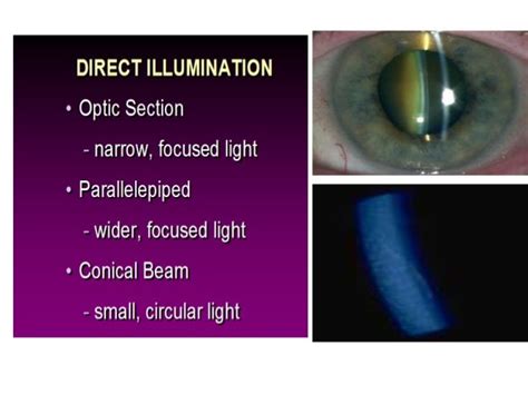 Slit Lamp Biomicroscopy