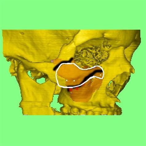 The Effect of Malar Augmentation – Cavendish Implants