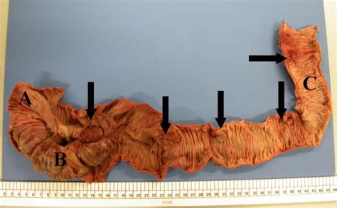 Specimen Of Limited Right Hemicolectomy Showing Terminal Ileum [a