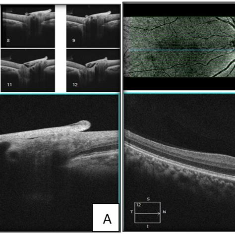 A Zeiss Fundus Visucam Posterior Segment Of Right Eye Showing