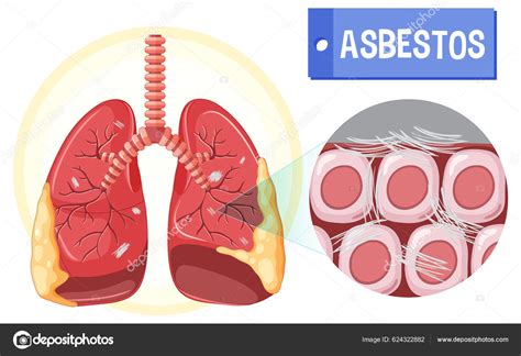 Diagram Showing Asbestosis Lungs Illustration Stock Vector By