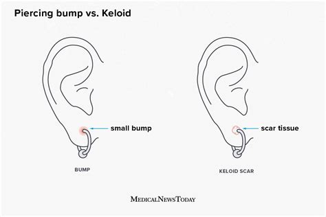 Hypertrophic Scar Vs Keloid Piercing