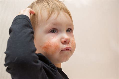 Managing childhood eczema: a visual guide - The Pharmaceutical Journal