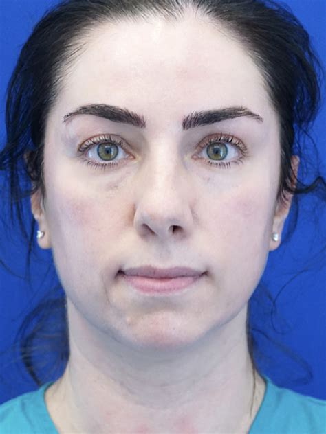 Cases In Rhinoplasty External Mao Facial Plastics