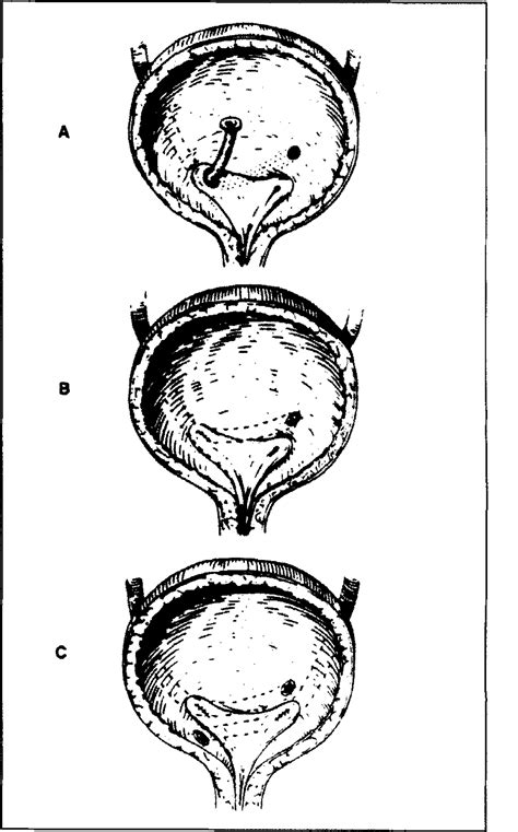 Surgical Management Of Vesicoureteral Reflux Ellsworth 2000 Aorn