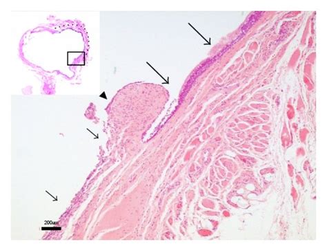 The Thyroglossal Duct And Cyst A The Extirpated Specimen Consists Of