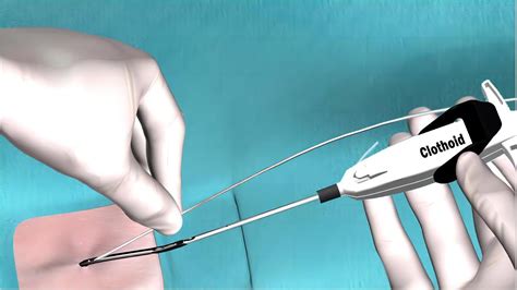 disposable vascular closure device weiyuan medical device