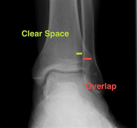 High Ankle Sprain Syndesmotic Injury The Bone School