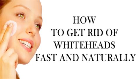 home remedies for whiteheads | | Netmarkers- Trending, Viral Stuff