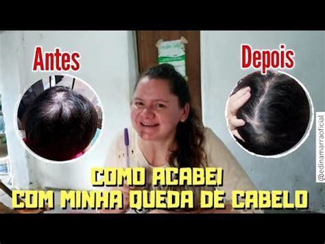 Como Resolvi O Problema Da Minha Queda De Cabelo Mais Aten O Um