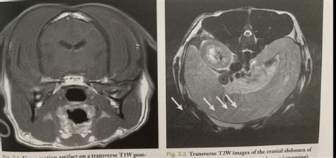 Neuroradiology - MRI artifacts Flashcards | Quizlet