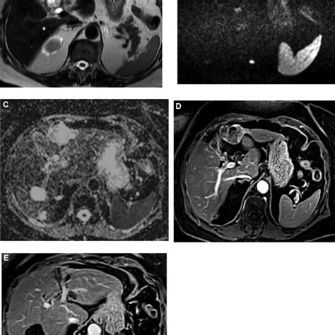 Mri Of A Typical Hemangioma In Liver Segment Viii T Weighted Imaging Hot Sex Picture