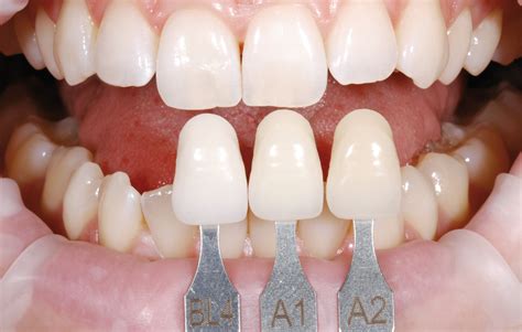 Ips E Max Press Glass Ceramic Restorations Ivoclar