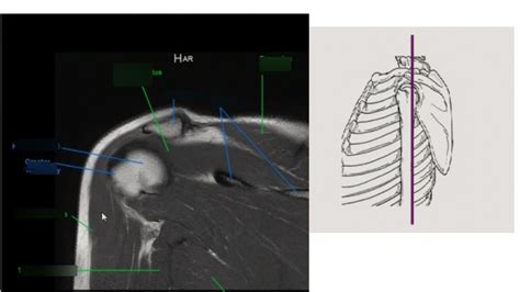 Shoulder Image Diagram Quizlet