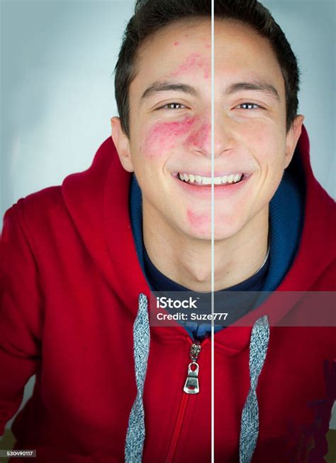 십대 남자아이 인물 여드름 여드름에 대한 스톡 사진 및 기타 이미지 여드름 사람 얼굴 귀여운 Istock