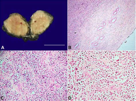 SciELO Brasil Myeloid Sarcoma An Uncommon Presentation Of Myeloid