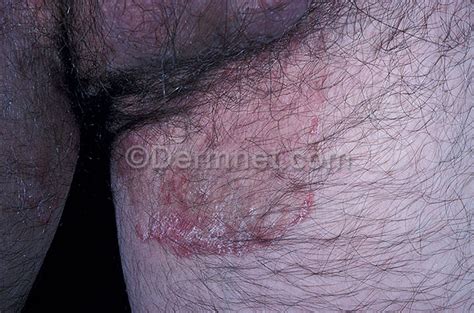 Tinea Ringworm Groin Photo Skin Disease Pictures