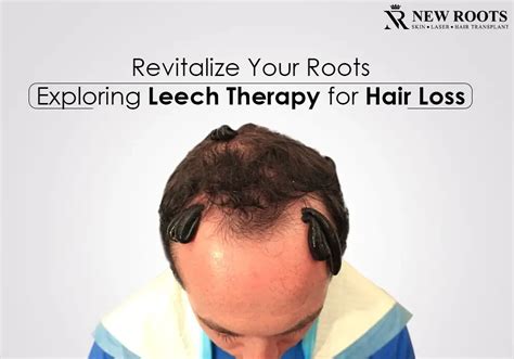 Leech Therapy For Hair Loss Natural Scalp Rejuvenation