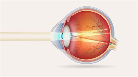 Why does astigmatism affect our night vision?