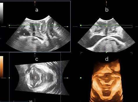 A The Midsagittal Plane B Coronal Plane C Axial Plane On 3d Pelvic