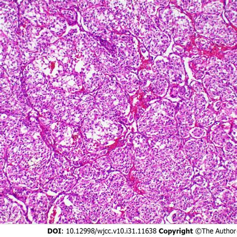 Histological Examinations Of The Pancreatic Tumor Hematoxylin Eosin