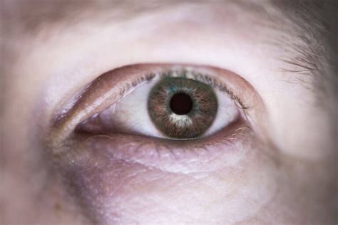 Cornea Transplant Surgery: Definition, 2 Types, Indication, Purposes ...