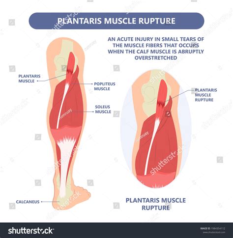 Calf Pain Leg Back Muscle Blood Stock Vector (Royalty Free) 1984354112