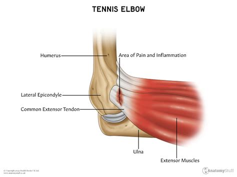 Tennis Elbow | Self-Help | AnatomyStuff