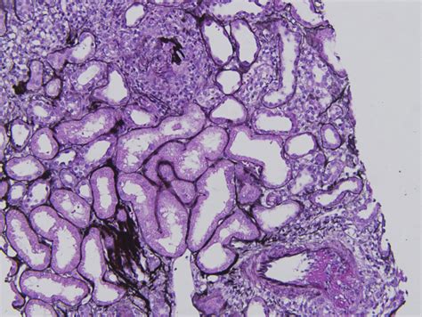 Ajkd Atlas Of Renal Pathology Pauci Immune Necrotizing Crescentic Glomerulonephritis American