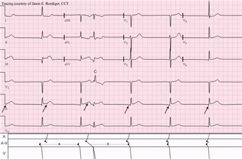 Junctional escape rhythm | ECG Guru - Instructor Resources