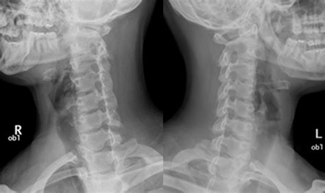 Radr Cervical C Spine Ap Axial Oblique Projection Rpo And Lpo