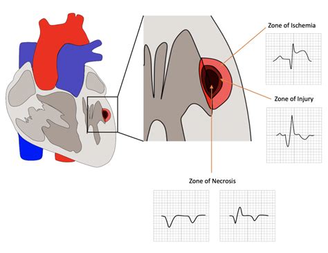 Topic Electro Pathophysiology 12 Lead Ecg Certification Course