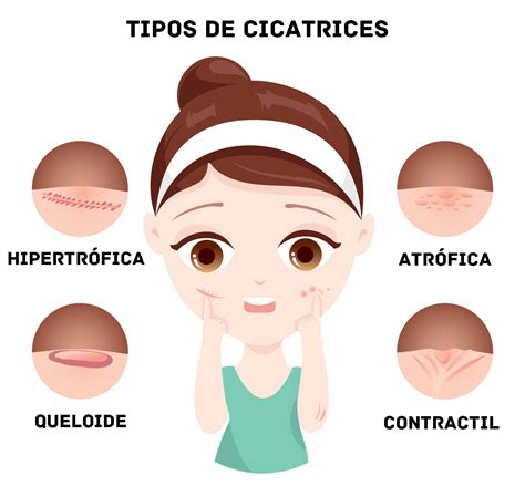 Cicatriz Atrófica Hipertrófica y Queloide Definición Concepto y Qué es