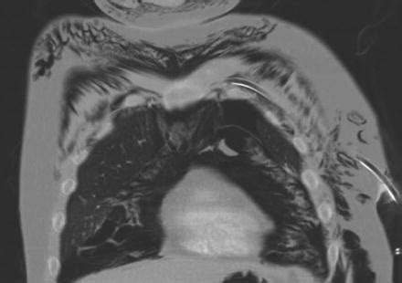 Complications of Chest Drain Insertion and Management | Thoracic Key