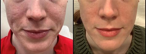 Fractional Co2 Laser Skin Resurfacing In Washington Dc