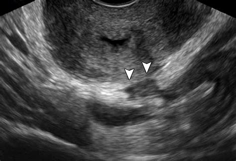 Findings Of Pelvic Endometriosis At Transvaginal Us Mr Imaging And