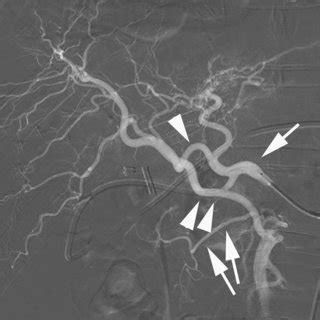 Cta Of The Liver Demonstrating The Proper Hepatic Artery Double