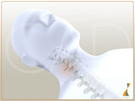 Arthrod Se Cervicale Centre Aquitain Du Dos