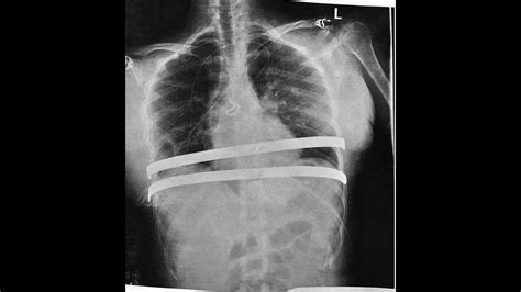 Modified Nuss Procedure For Pectus Excavatum Youtube Otosection