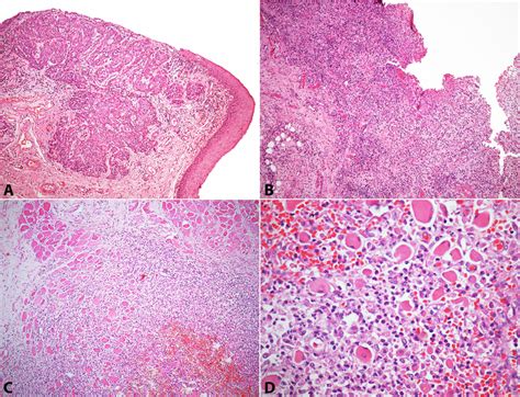 Photomicrography Of The Uvula And Parapharyngeal Tissue A Invasive