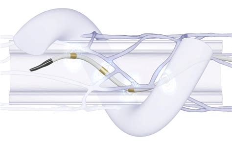 Renal Denervation System China Med Device