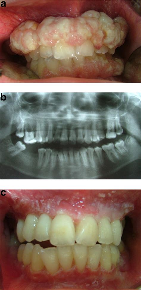 Ligneous Periodontitis And Gingival Antioxidant Status Report Of Two