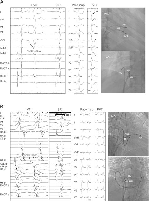 Activation Mapping Pace Mapping And Fluoroscopic Images Of The