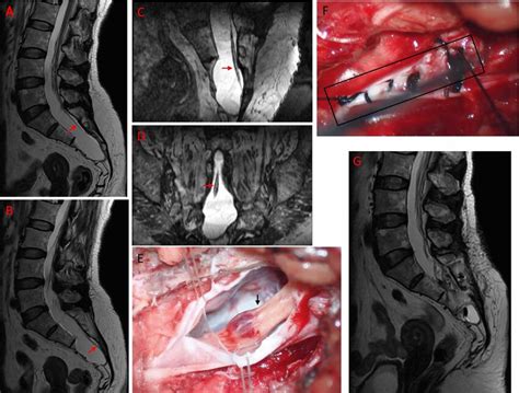 A, B. Preoperative MRI scanning showed huge cyst at S2-4 level with ...