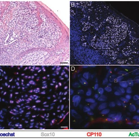 Melanocytes in invasive melanoma frequently fail to possess a primary... | Download Scientific ...