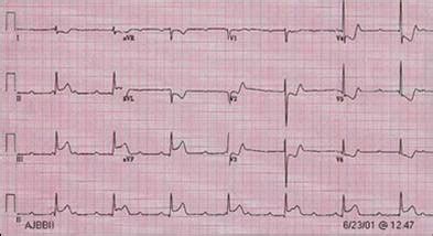 Management of STEMI and its Complications - RCEMLearning