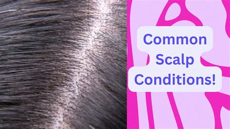 Common Scalp Conditions A Comprehensive Guide Hairnimation